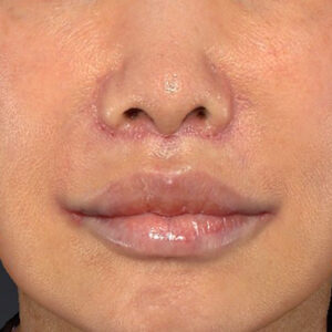 新宿ラクル美容外科クリニック　山本厚志　「人中短縮術（リップリフト）＋口角挙上（スマイルリップ）」　手術後１週間目　２月６日