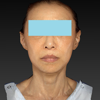 After image