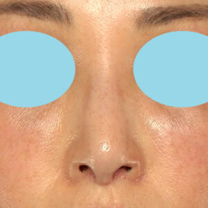 新宿ラクル美容外科クリニック　山本厚志　「小鼻縮小+α法 ＋ 鼻孔縁下降術」　手術後１ヶ月目　２月７日