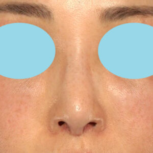 新宿ラクル美容外科クリニック　山本厚志　「小鼻縮小+α法 ＋ 鼻孔縁下降術」　手術後２ヶ月目　２月７日