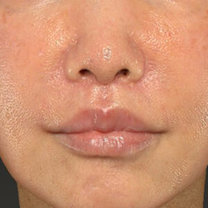 新宿ラクル美容外科クリニック　山本厚志　「人中短縮術（リップリフト）＋口角挙上（スマイルリップ）」　手術後２ヶ月目　２月６日