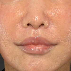 新宿ラクル美容外科クリニック　山本厚志　「人中短縮術（リップリフト）＋口角挙上（スマイルリップ）」　手術後３ヶ月目　２月２２日
