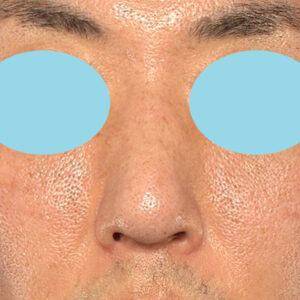 「ワシ鼻修正（ハンプ切除）」　新宿ラクル美容外科クリニック　４０代男性　手術後６ヶ月目　４月１４日