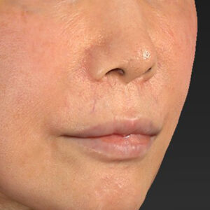 新宿ラクル美容外科クリニック　山本厚志　「人中短縮術（リップリフト）＋口角挙上（スマイルリップ）」　手術前　２月６日