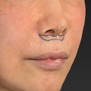 新宿ラクル美容外科クリニック　山本厚志　「人中短縮術（リップリフト）＋口角挙上（スマイルリップ）」　デザイン　２月６日