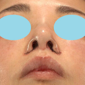 新宿ラクル美容外科クリニック　山本厚志　「小鼻縮小+α法 ＋ 鼻孔縁下降術」　手術直後　２月７日