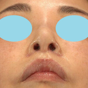 新宿ラクル美容外科クリニック　山本厚志　「小鼻縮小+α法 ＋ 鼻孔縁下降術」　手術後１週間目　２月７日