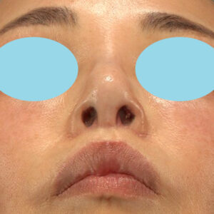 新宿ラクル美容外科クリニック　山本厚志　「小鼻縮小+α法 ＋ 鼻孔縁下降術」　手術後１ヶ月目　２月７日