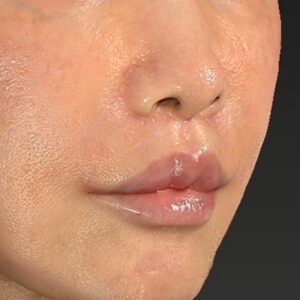 新宿ラクル美容外科クリニック　山本厚志　「人中短縮術（リップリフト）＋口角挙上（スマイルリップ）」　手術後１ヶ月目　２月６日