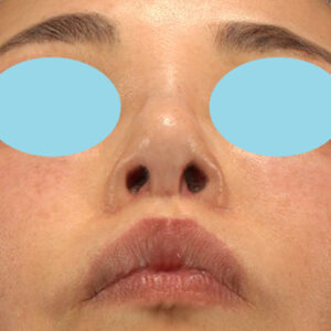 新宿ラクル美容外科クリニック　山本厚志　「小鼻縮小+α法 ＋ 鼻孔縁下降術」　手術後２ヶ月目　２月７日