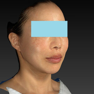 新宿ラクル美容外科クリニック　山本厚志　ナチュラルフェイスネックリフト　手術後３ヶ月目　１月１９日