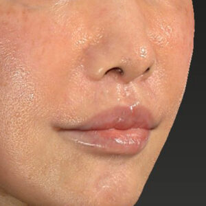 新宿ラクル美容外科クリニック　山本厚志　「人中短縮術（リップリフト）＋口角挙上（スマイルリップ）」　手術後３ヶ月目　２月２２日