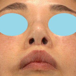 新宿ラクル美容外科クリニック　山本厚志　「小鼻縮小+α法 ＋ 鼻孔縁下降術」　手術後３ヶ月目　３月２３日