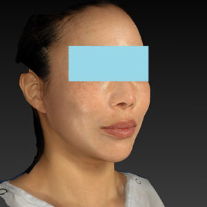 新宿ラクル美容外科クリニック　山本厚志　ナチュラルフェイスネックリフト　手術後６ヶ月目　１月１９日