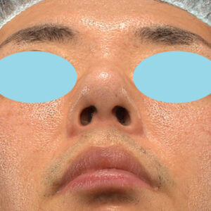 「ワシ鼻修正（ハンプ切除）」　新宿ラクル美容外科クリニック　４０代男性　手術後６ヶ月目　４月１４日