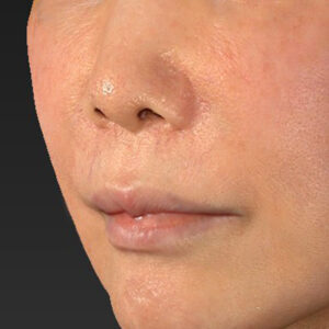 新宿ラクル美容外科クリニック　山本厚志　「人中短縮術（リップリフト）＋口角挙上（スマイルリップ）」　手術前　２月６日