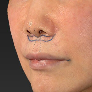 新宿ラクル美容外科クリニック　山本厚志　「人中短縮術（リップリフト）＋口角挙上（スマイルリップ）」　デザイン　２月６日