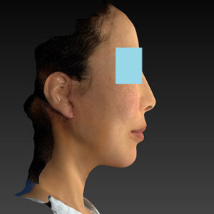 新宿ラクル美容外科クリニック　山本厚志　ナチュラルフェイスネックリフト　手術後１週間目　６月７日