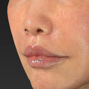 新宿ラクル美容外科クリニック　山本厚志　「人中短縮術（リップリフト）＋口角挙上（スマイルリップ）」　手術後１ヶ月目　２月６日