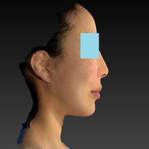 新宿ラクル美容外科クリニック　山本厚志　ナチュラルフェイスネックリフト　手術後１ヶ月目　６月７日