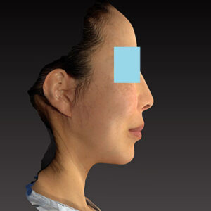 新宿ラクル美容外科クリニック　山本厚志　ナチュラルフェイスネックリフト　手術後２ヶ月目　６月７日