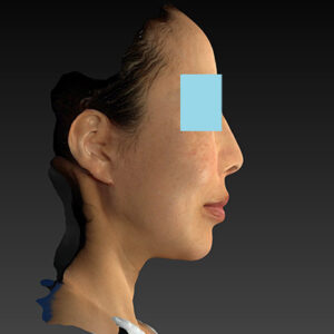 新宿ラクル美容外科クリニック　山本厚志　ナチュラルフェイスネックリフト　手術後３ヶ月目　１月１９日