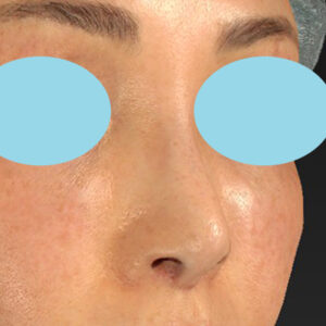 新宿ラクル美容外科クリニック　山本厚志　「小鼻縮小+α法 ＋ 鼻孔縁下降術」　手術後３ヶ月目　３月２３日