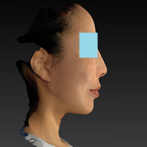 新宿ラクル美容外科クリニック　山本厚志　ナチュラルフェイスネックリフト　手術後６ヶ月目　１月１９日