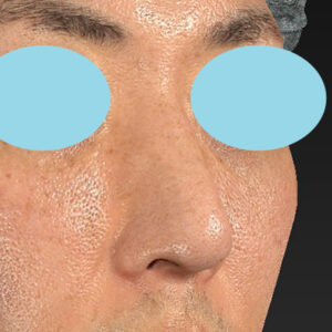 「ワシ鼻修正（ハンプ切除）」　新宿ラクル美容外科クリニック　４０代男性　手術後６ヶ月目　４月１４日