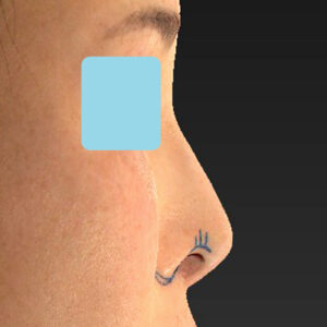 新宿ラクル美容外科クリニック　山本厚志　「小鼻縮小+α法 ＋ 鼻孔縁下降術」　デザイン　２月７日