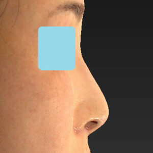 新宿ラクル美容外科クリニック　山本厚志　「小鼻縮小+α法 ＋ 鼻孔縁下降術」　手術後１週間目　２月７日