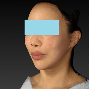 新宿ラクル美容外科クリニック　山本厚志　ナチュラルフェイスネックリフト　手術後１２ヶ月目　２月１５日