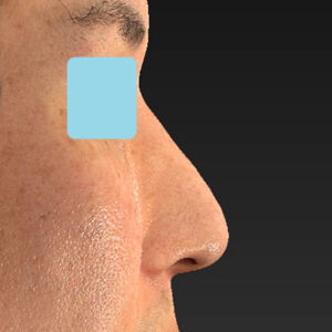 「ワシ鼻修正（ハンプ切除）」　新宿ラクル美容外科クリニック　４０代男性　手術後６ヶ月目　４月１４日