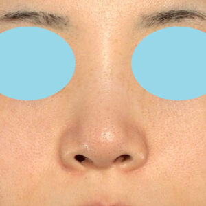 「耳介軟骨移植＋鼻尖縮小（close法）＋小鼻縮小+α」　新宿ラクル美容外科クリニック　２０代女性　手術前　３月２９日