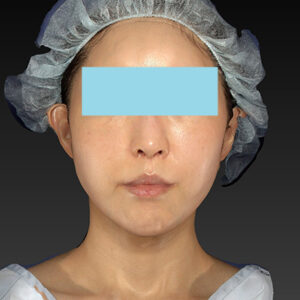 新宿ラクル美容外科クリニック　山本厚志　「アルテミスリフト」　手術前　３月３０日