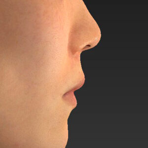 新宿ラクル美容外科クリニック　山本厚志　「猫手術（鼻唇角形成術）+ 貴族手術（鼻翼基部プロテーゼ）」　手術前　３月１日