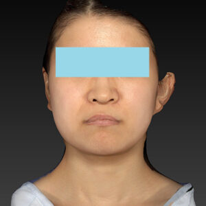 新宿ラクル美容外科クリニック　山本厚志　「ナチュラルフェイスリフト」「ライポライフ脂肪吸引（メーラーファット+ジョールファット）」　手術前　３月２０日