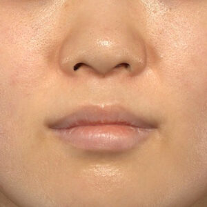 新宿ラクル美容外科クリニック　山本厚志　「猫手術（鼻唇角形成術）+ 貴族手術（鼻翼基部プロテーゼ）」　手術前　３月２５日