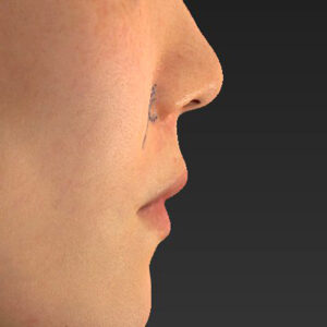 新宿ラクル美容外科クリニック　山本厚志　「猫手術（鼻唇角形成術）+ 貴族手術（鼻翼基部プロテーゼ）」　デザイン　３月１日