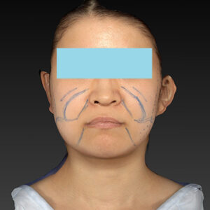 新宿ラクル美容外科クリニック　山本厚志　「ナチュラルフェイスリフト」「ライポライフ脂肪吸引（メーラーファット+ジョールファット）」　デザイン　３月２０日