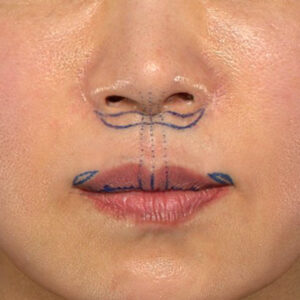 新宿ラクル美容外科クリニック　山本厚志　「外側人中短縮術（上口唇挙上術）+ 人中短縮術（リップリフト）＋口唇縮小」　デザイン　３月２８日