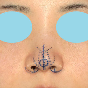 「耳介軟骨移植＋鼻尖縮小（close法）＋小鼻縮小+α」　新宿ラクル美容外科クリニック　２０代女性　デザイン　３月２９日