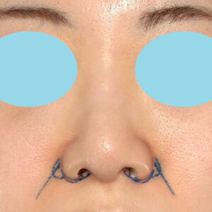 新宿ラクル美容外科クリニック　山本厚志　「貴族手術（鼻翼基部プロテーゼ）＋ 小鼻縮小+α法」　デザイン　３月３１日