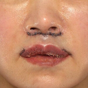 新宿ラクル美容外科クリニック　山本厚志　「外側人中短縮術（上口唇挙上術）+ 人中短縮術（リップリフト）＋口唇縮小」　手術直後　３月２８日