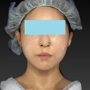 新宿ラクル美容外科クリニック　山本厚志　「アルテミスリフト」　手術直後　３月３０日