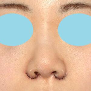 新宿ラクル美容外科クリニック　山本厚志　「貴族手術（鼻翼基部プロテーゼ）＋ 小鼻縮小+α法」　手術直後　３月３１日