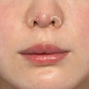 新宿ラクル美容外科クリニック　山本厚志　「貴族手術（鼻翼基部プロテーゼ）」　手術直後　３月５日