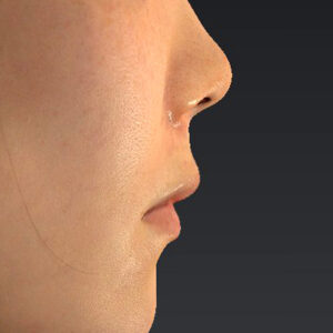 新宿ラクル美容外科クリニック　山本厚志　「猫手術（鼻唇角形成術）+ 貴族手術（鼻翼基部プロテーゼ）」　手術直後　３月１日