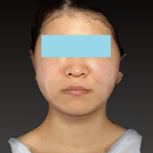 新宿ラクル美容外科クリニック　山本厚志　「ナチュラルフェイスリフト」「ライポライフ脂肪吸引（メーラーファット+ジョールファット）」　手術直後　３月２０日