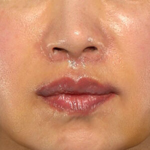 新宿ラクル美容外科クリニック　山本厚志　「外側人中短縮術（上口唇挙上術）+ 人中短縮術（リップリフト）＋口唇縮小」　手術後１週間目　３月２８日